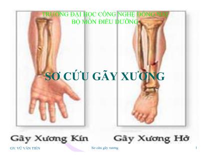 Bài giảng môn Điều dưỡng - Sơ cứu gãy xương - Vũ Văn Tiến